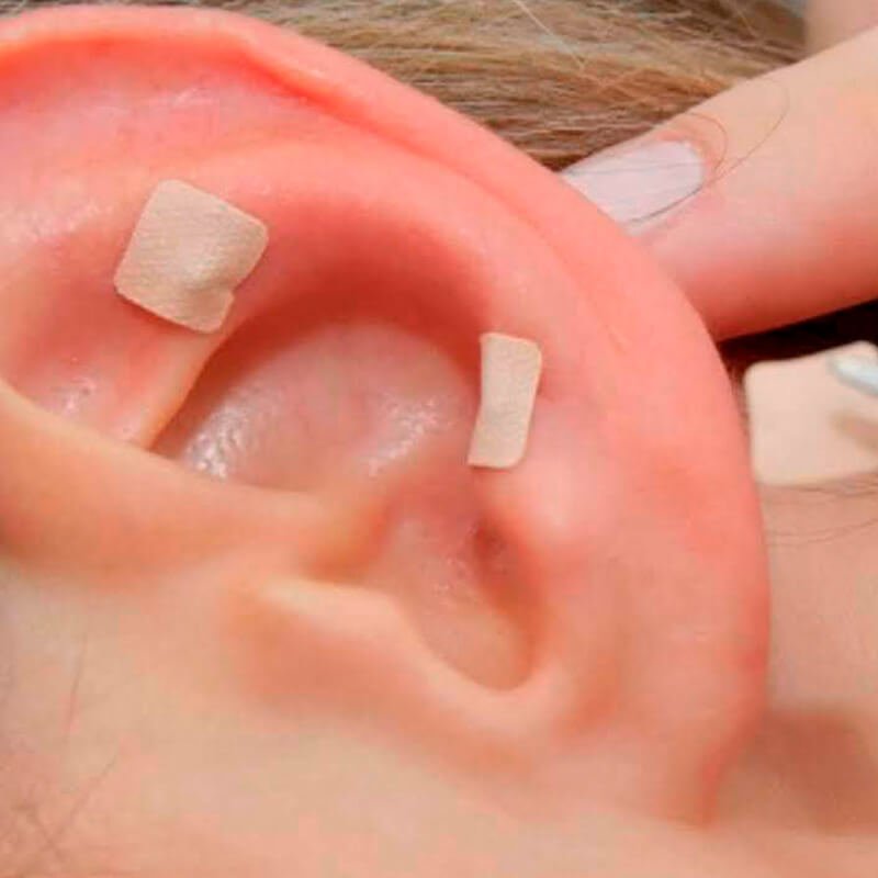 Auriculoterapia